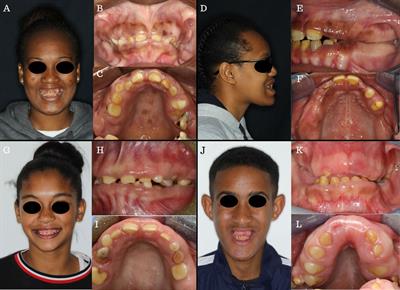 Case report: Enamel renal syndrome: a case series from sub-Saharan Africa